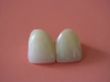 1b-sharon-crowns-from-labial