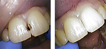 Composite fillings before and after